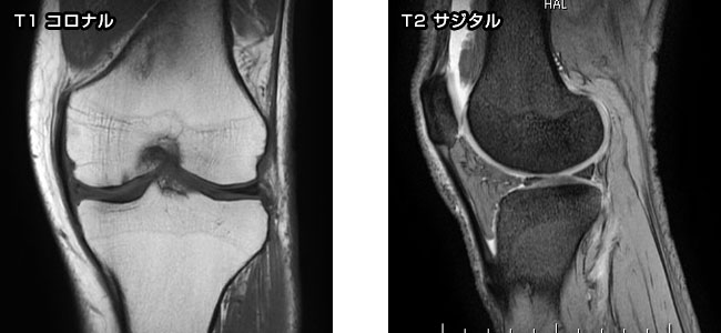 膝関節画像