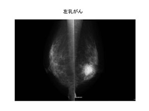 左乳がん