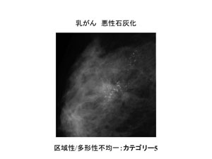 乳がん　悪性石灰化