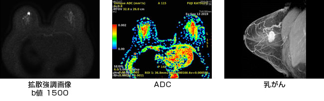 拡散強調画像、ADC、乳がん画像